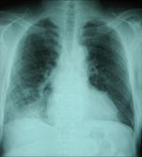 肺炎の胸部X線写真