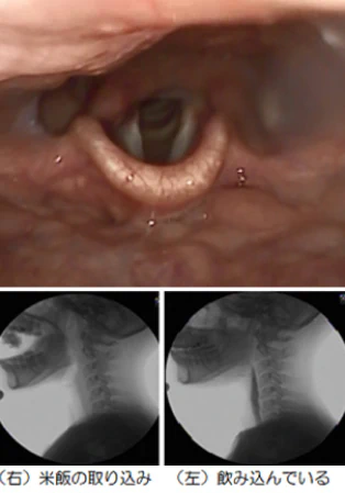 嚥下内視鏡検査・嚥下造影検査