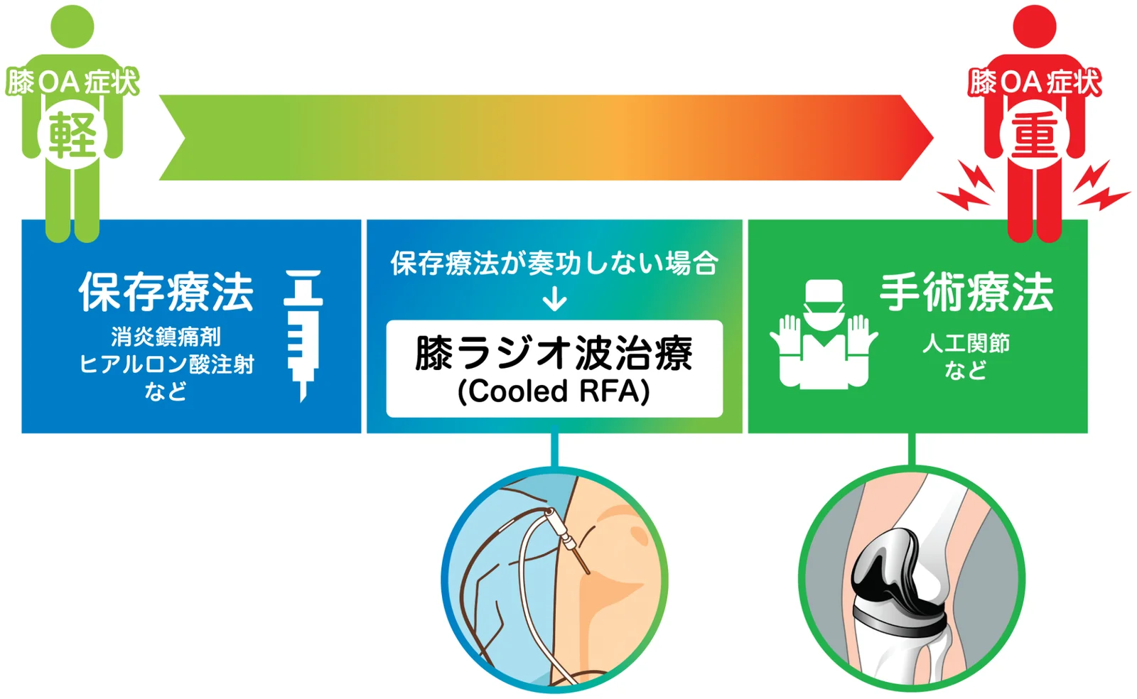 膝の痛みの治療の流れ。保存療法(消炎鎮痛剤・ヒアルロン酸注射など)で効果が不十分な場合に、手術療法の前の選択肢としてひざラジオ波治療がある図